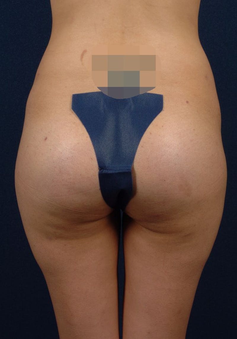 Gluteal Augmentation Before & After Gallery - Patient 9421732 - Image 2