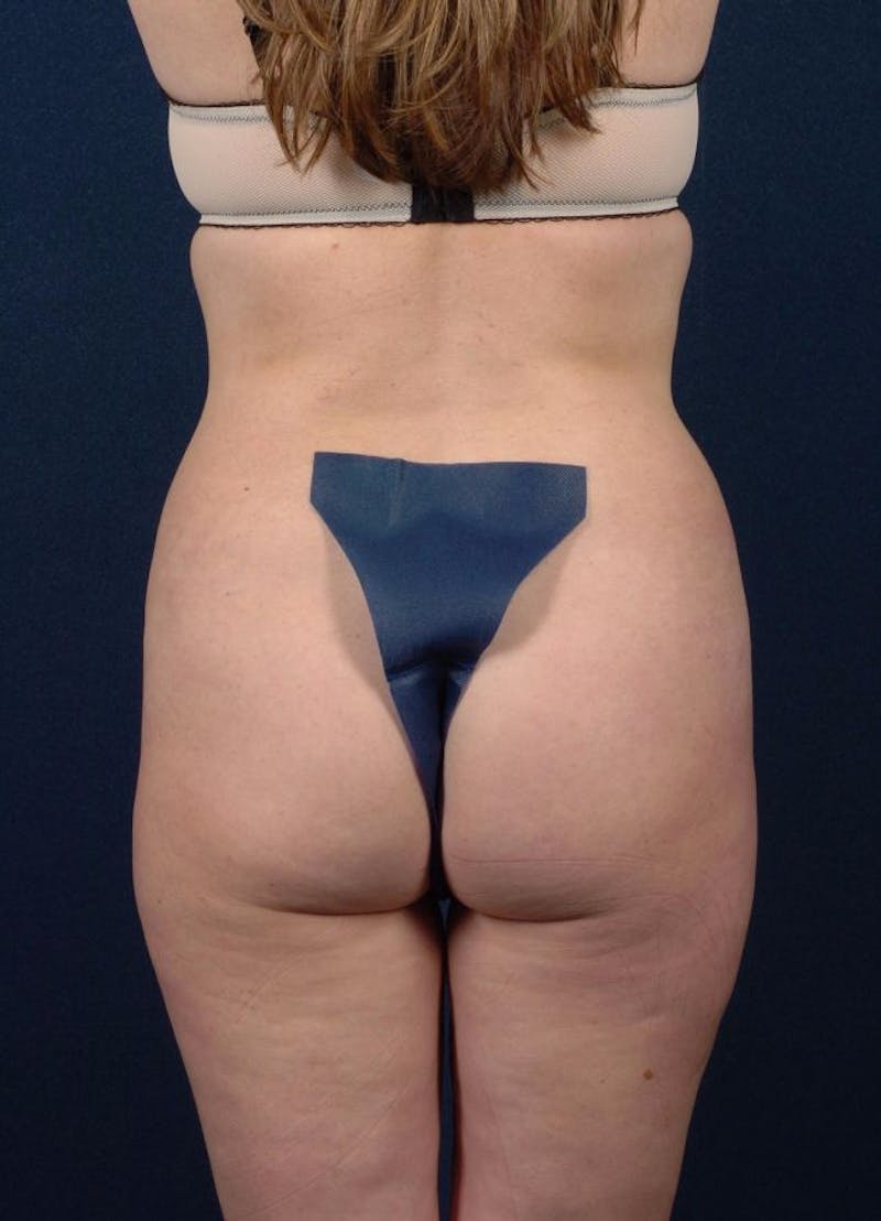Female Liposuction Gallery - Patient 9421731 - Image 4