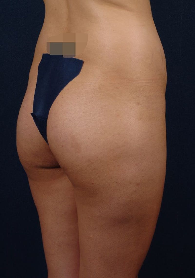 Gluteal Augmentation Before & After Gallery - Patient 9421732 - Image 3