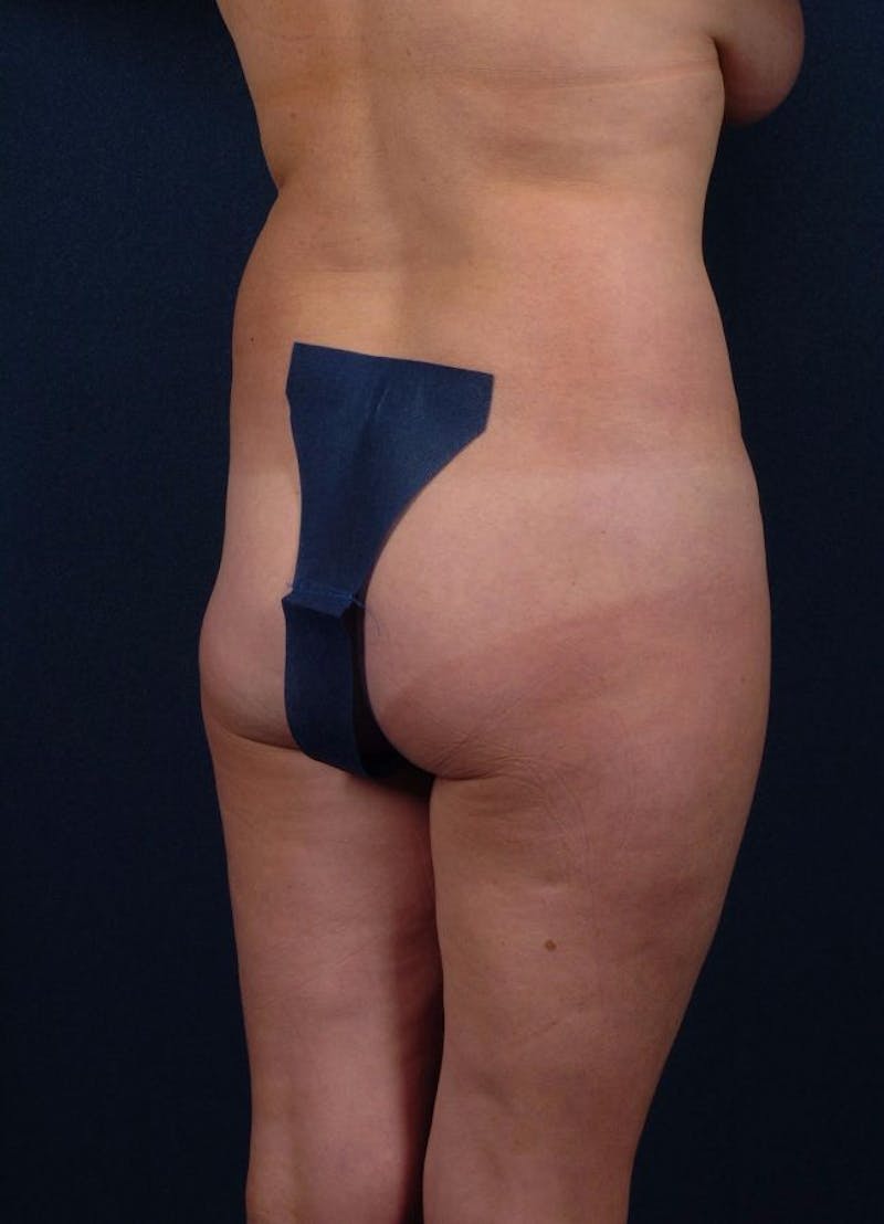 Female Liposuction Gallery - Patient 9421731 - Image 5