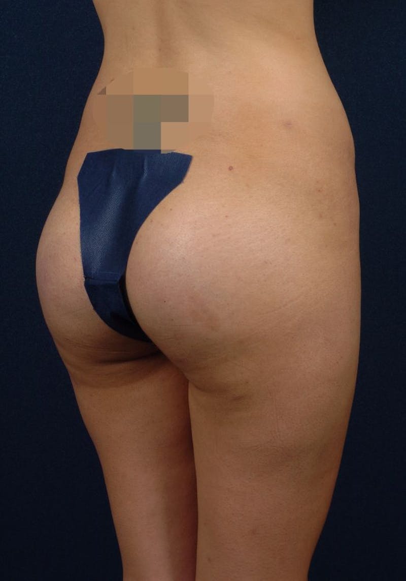 Gluteal Augmentation Before & After Gallery - Patient 9421732 - Image 4