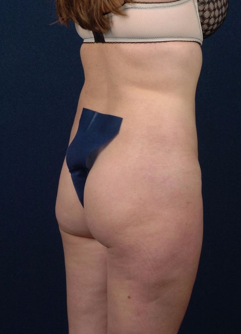 Female Liposuction Before & After Gallery - Patient 9421731 - Image 6