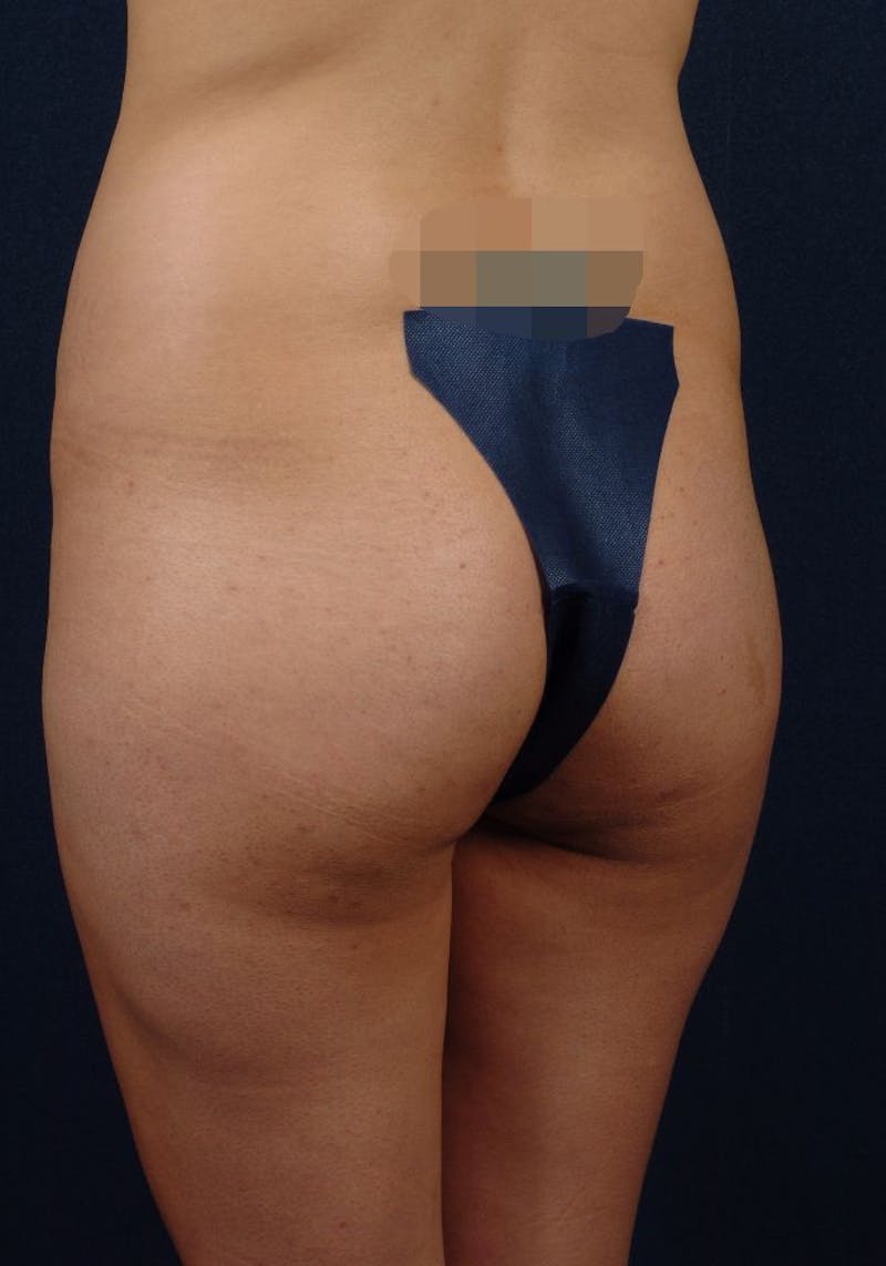 Gluteal Augmentation Before & After Gallery - Patient 9421732 - Image 5