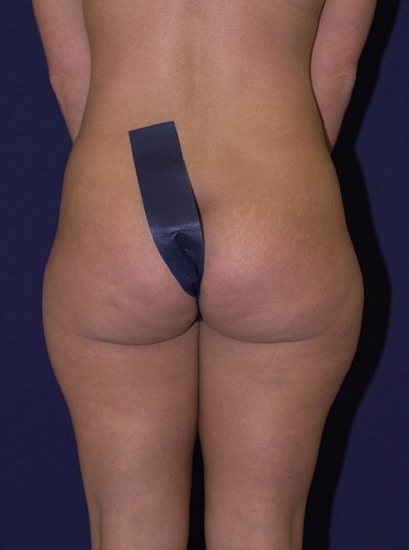 Female Liposuction Before & After Gallery - Patient 9421735 - Image 1