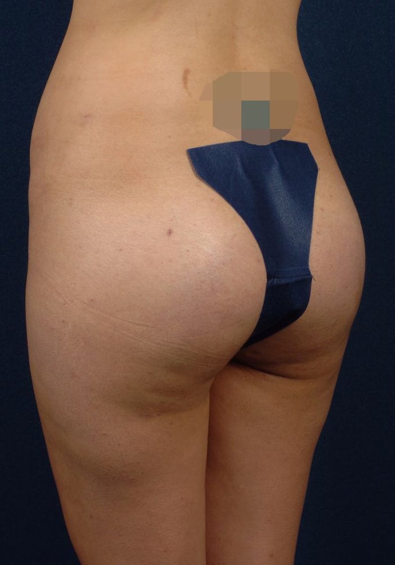 Gluteal Augmentation Gallery - Patient 9421732 - Image 6