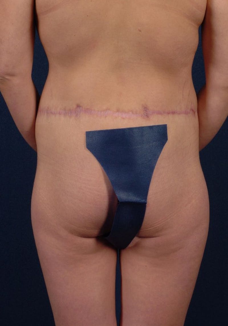 Gluteal Augmentation Before & After Gallery - Patient 9421736 - Image 1