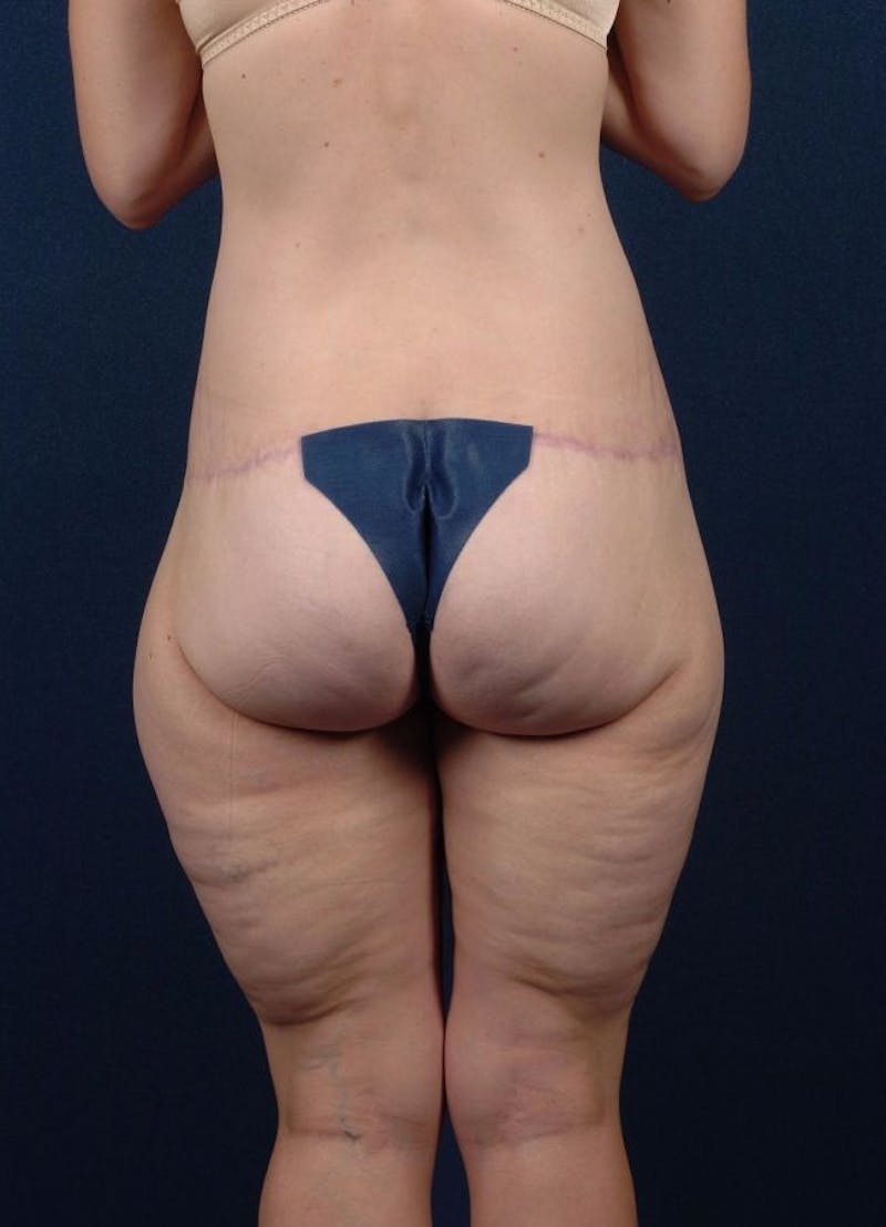 Patient 9421734, Extreme Body Contouring Before & After Photos