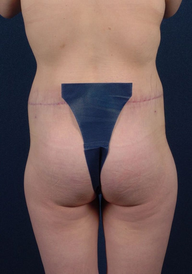 Gluteal Augmentation Gallery - Patient 9421736 - Image 2