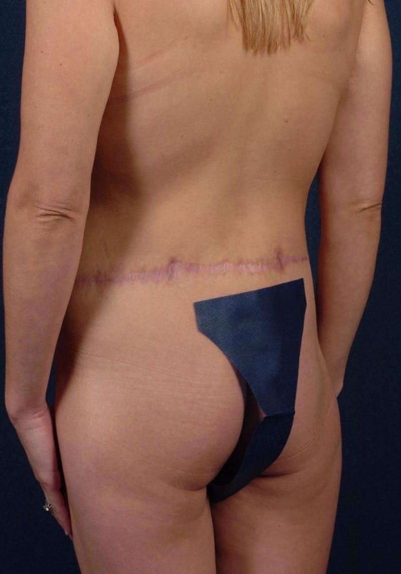 Gluteal Augmentation Before & After Gallery - Patient 9421736 - Image 3