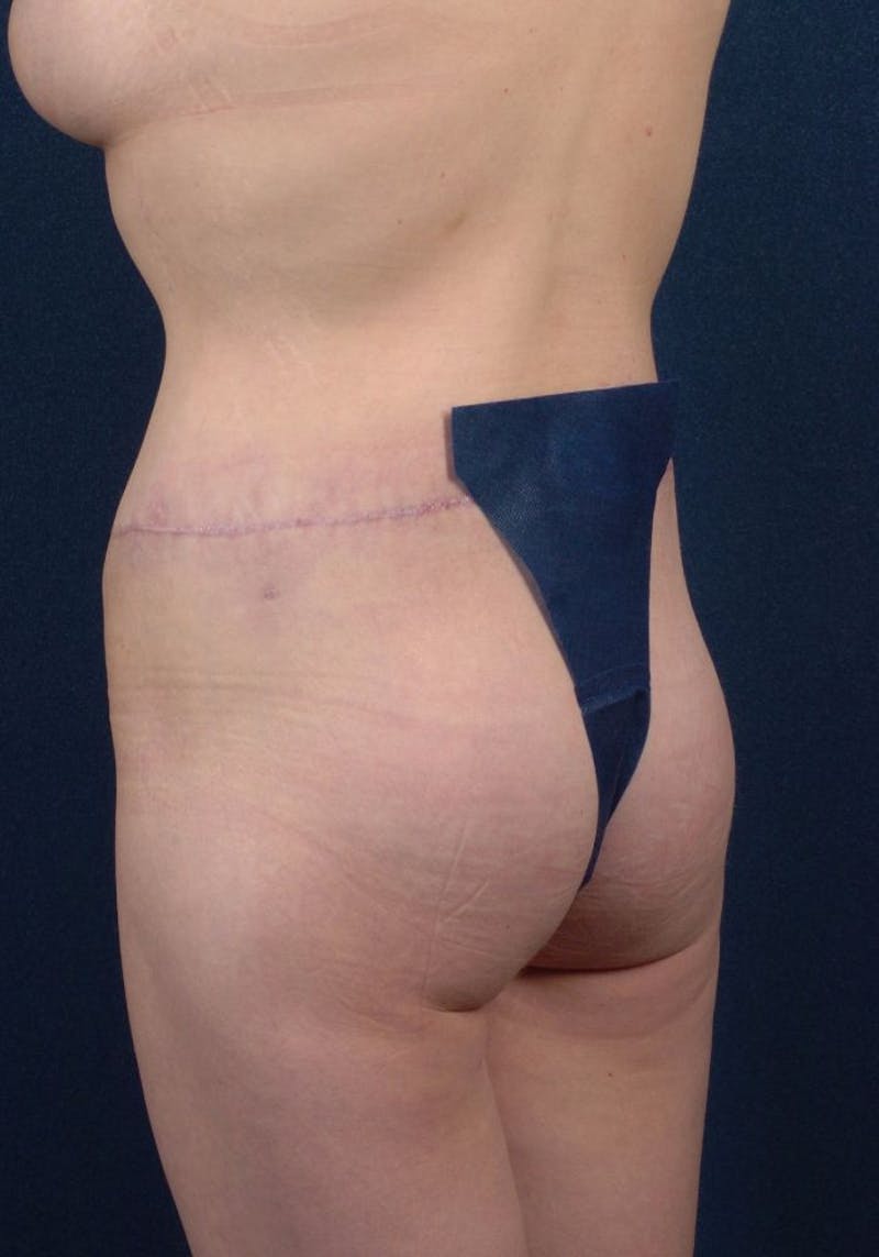 Gluteal Augmentation Gallery - Patient 9421736 - Image 4