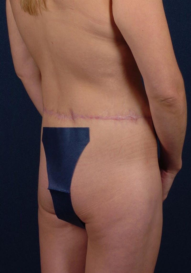 Gluteal Augmentation Before & After Gallery - Patient 9421736 - Image 5