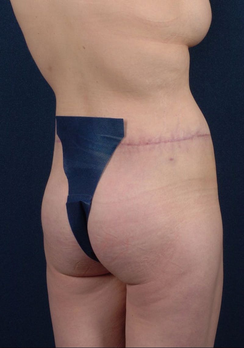 Gluteal Augmentation Before & After Gallery - Patient 9421736 - Image 6