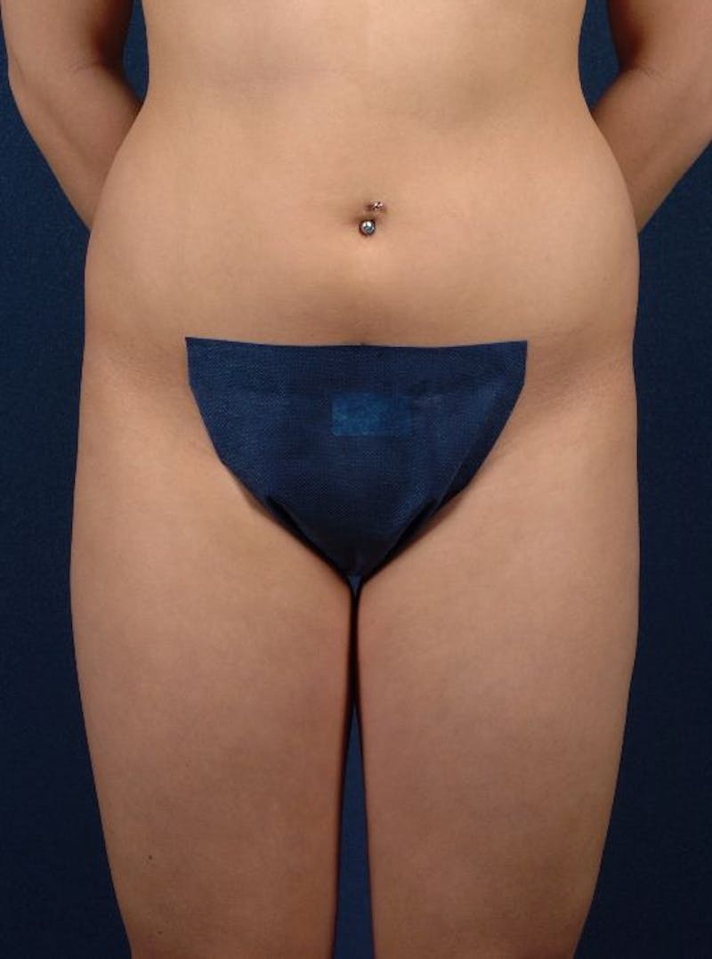 Female Liposuction Before & After Gallery - Patient 9421739 - Image 1