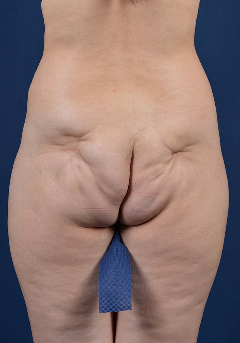 Gluteal Augmentation Before & After Gallery - Patient 9421741 - Image 1