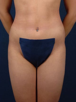 Female Liposuction Before & After Gallery - Patient 9421739 - Image 2