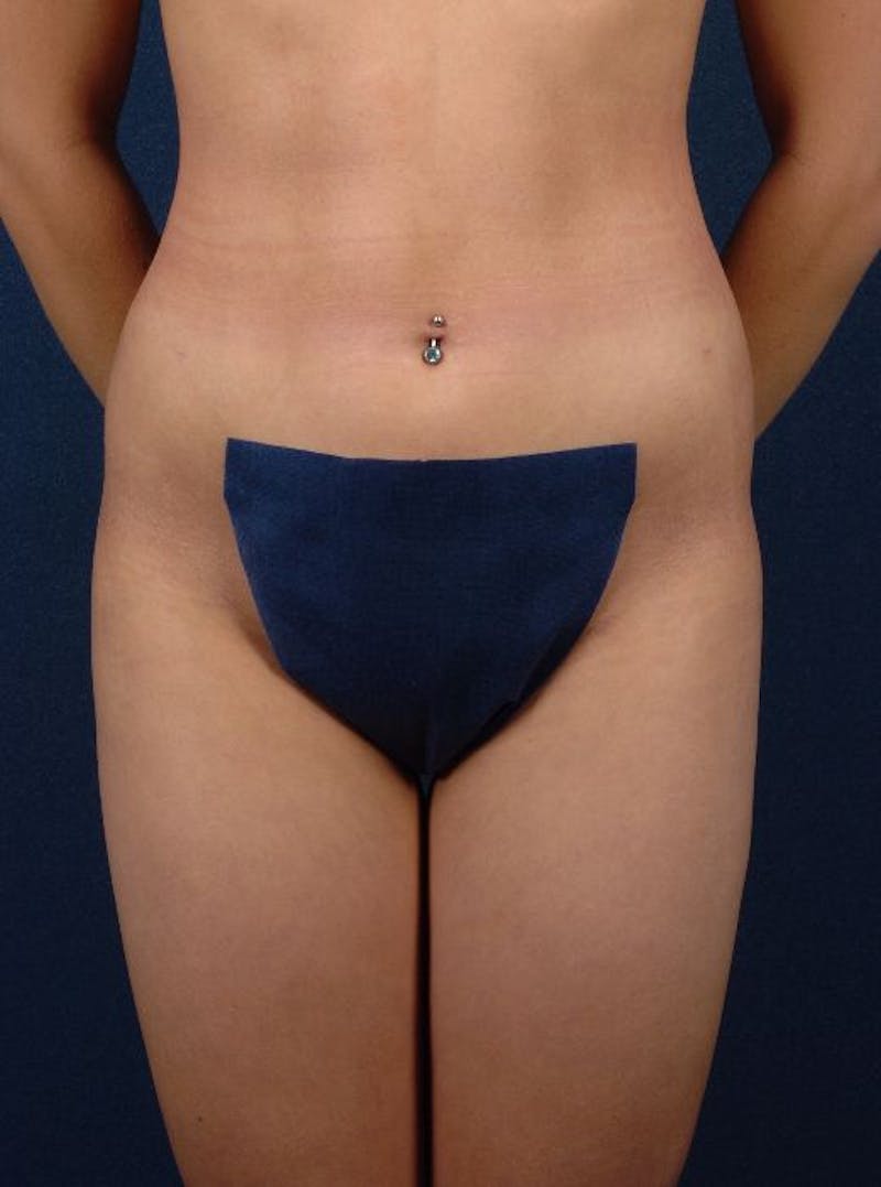 Female Liposuction Before & After Gallery - Patient 9421739 - Image 2