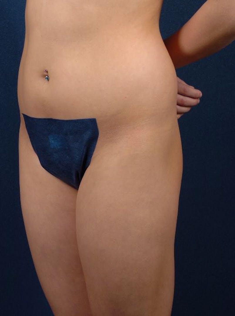 Female Liposuction Before & After Gallery - Patient 9421739 - Image 3