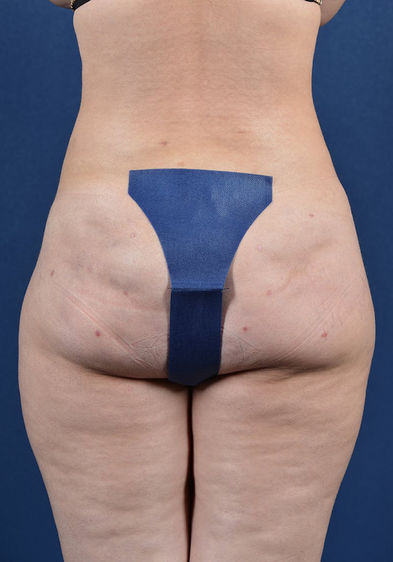 Gluteal Augmentation Before & After Gallery - Patient 9421741 - Image 2