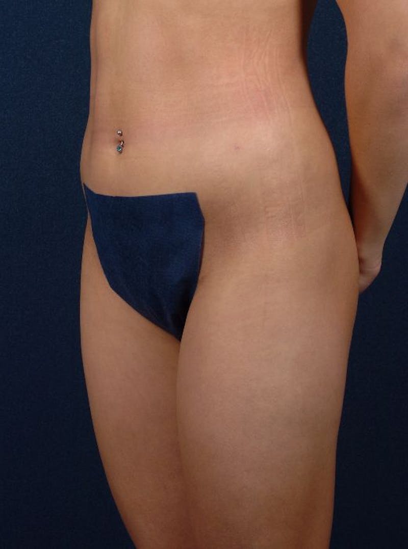 Female Liposuction Before & After Gallery - Patient 9421739 - Image 4