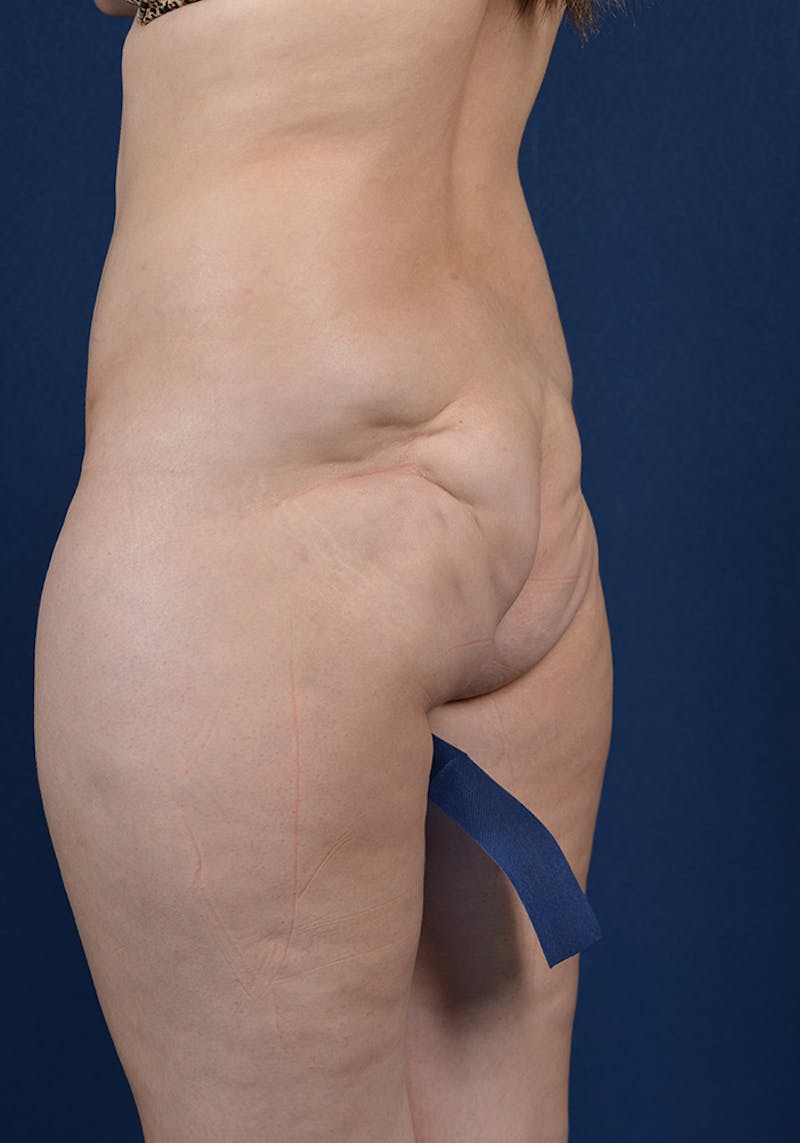 Gluteal Augmentation Before & After Gallery - Patient 9421741 - Image 3