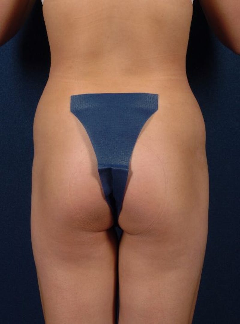 Female Liposuction Before & After Gallery - Patient 9421739 - Image 6