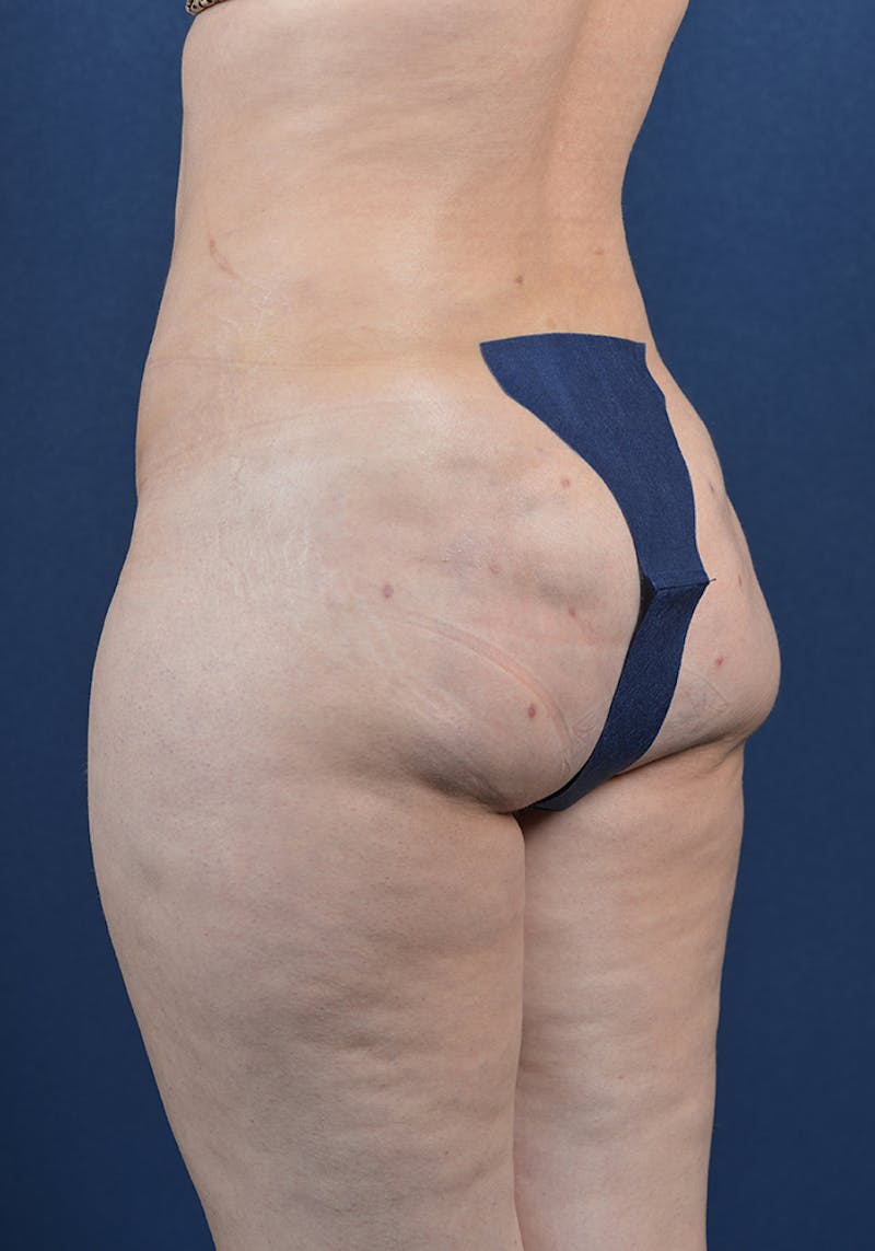Gluteal Augmentation Before & After Gallery - Patient 9421741 - Image 4