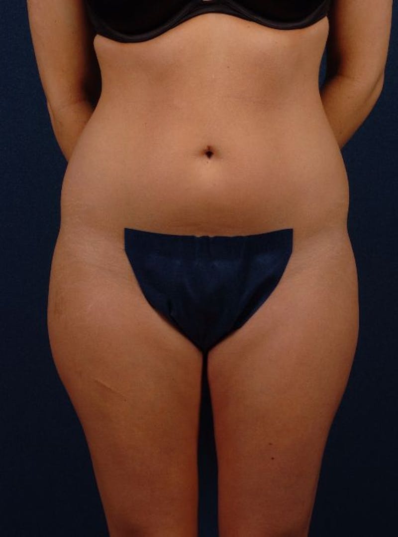 Female Liposuction Before & After Gallery - Patient 9421742 - Image 1
