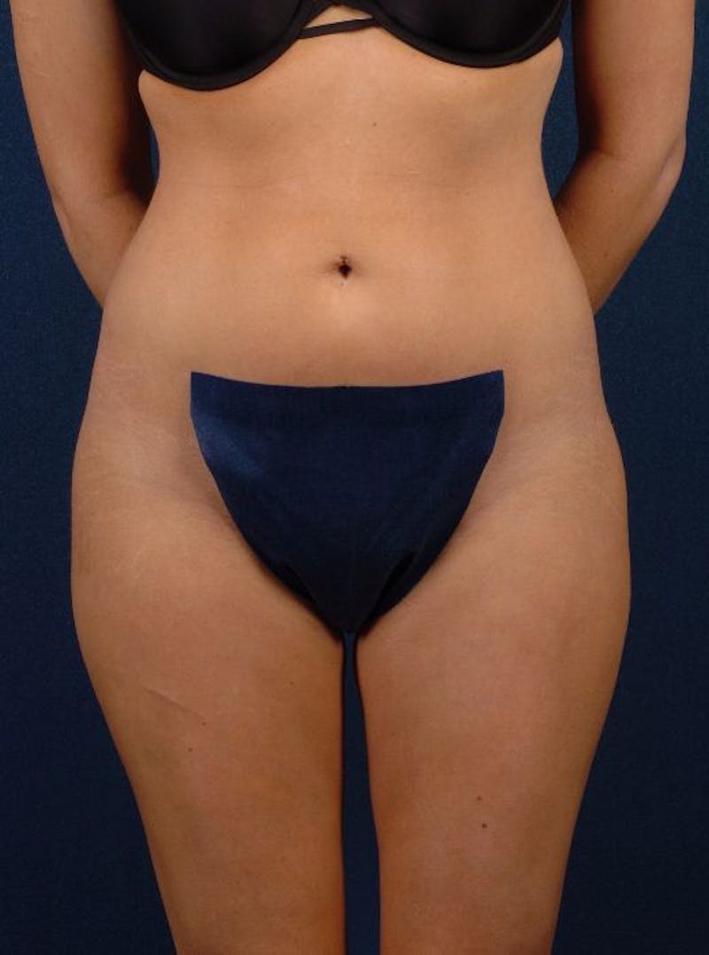 Female Liposuction Before & After Gallery - Patient 9421742 - Image 2