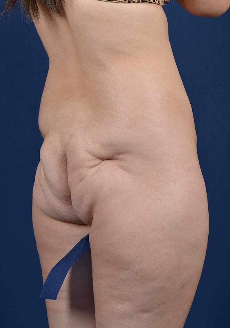 Gluteal Augmentation Gallery - Patient 9421741 - Image 5