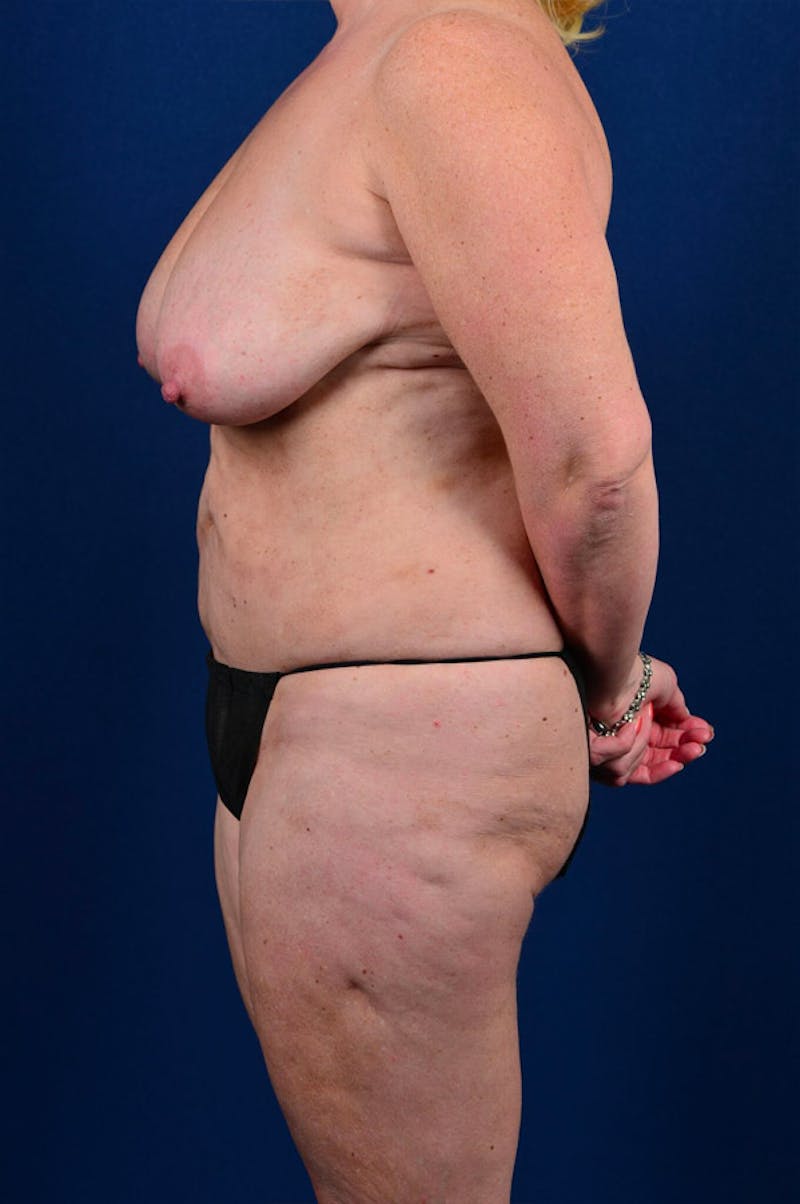 Extreme Body Contouring Before & After Gallery - Patient 9421740 - Image 5