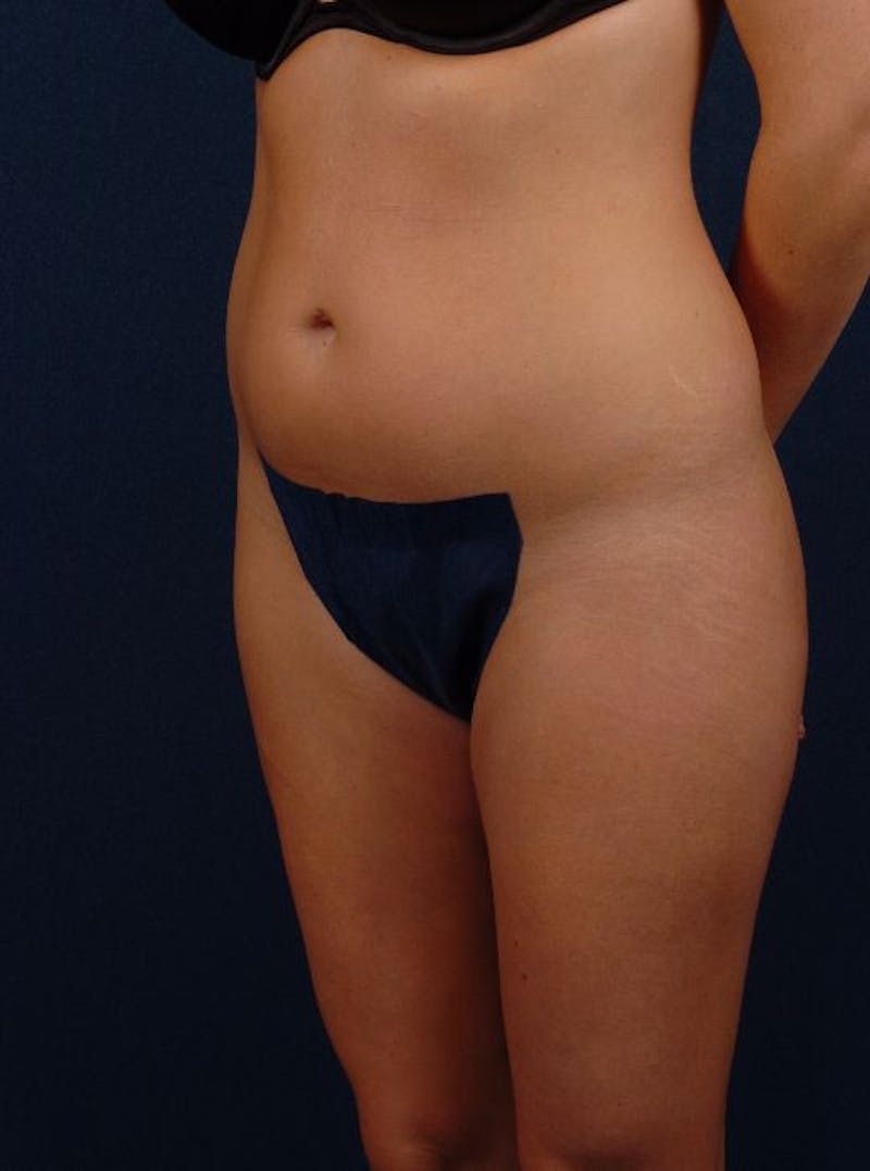 Female Liposuction Before & After Gallery - Patient 9421742 - Image 3