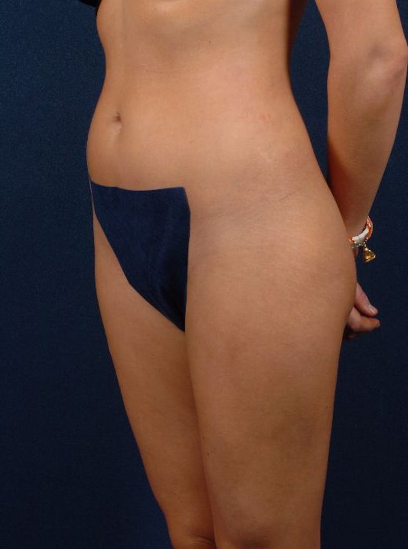 Female Liposuction Before & After Gallery - Patient 9421742 - Image 4