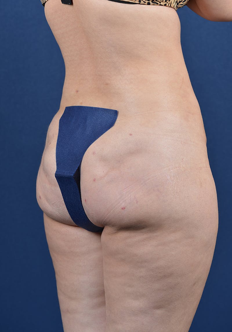 Gluteal Augmentation Before & After Gallery - Patient 9421741 - Image 6