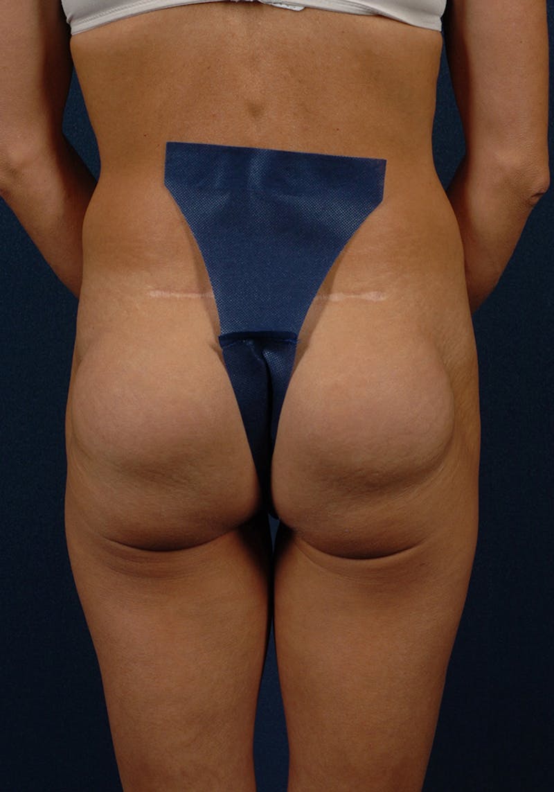 Gluteal Augmentation Before & After Gallery - Patient 9421747 - Image 1