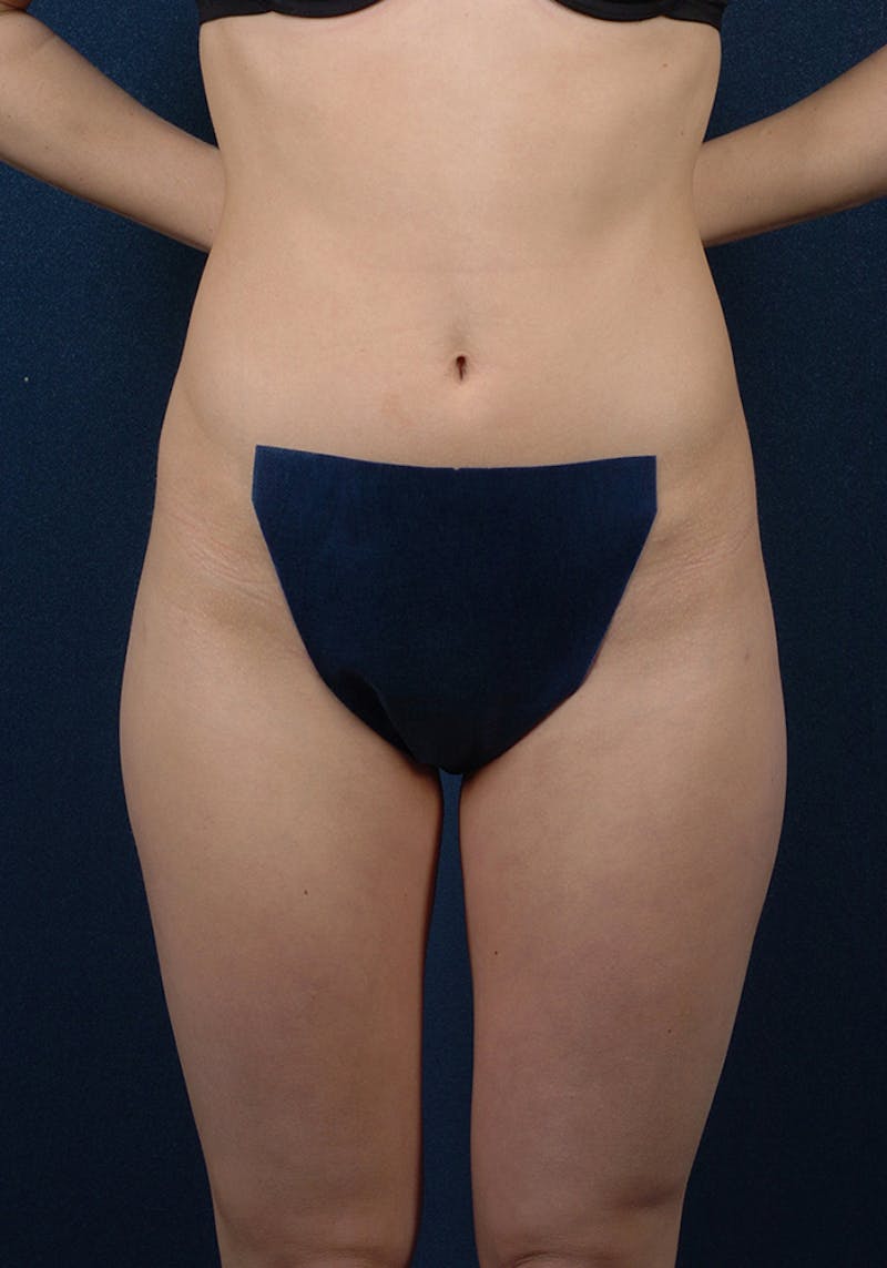 Female Liposuction Gallery - Patient 9421746 - Image 2