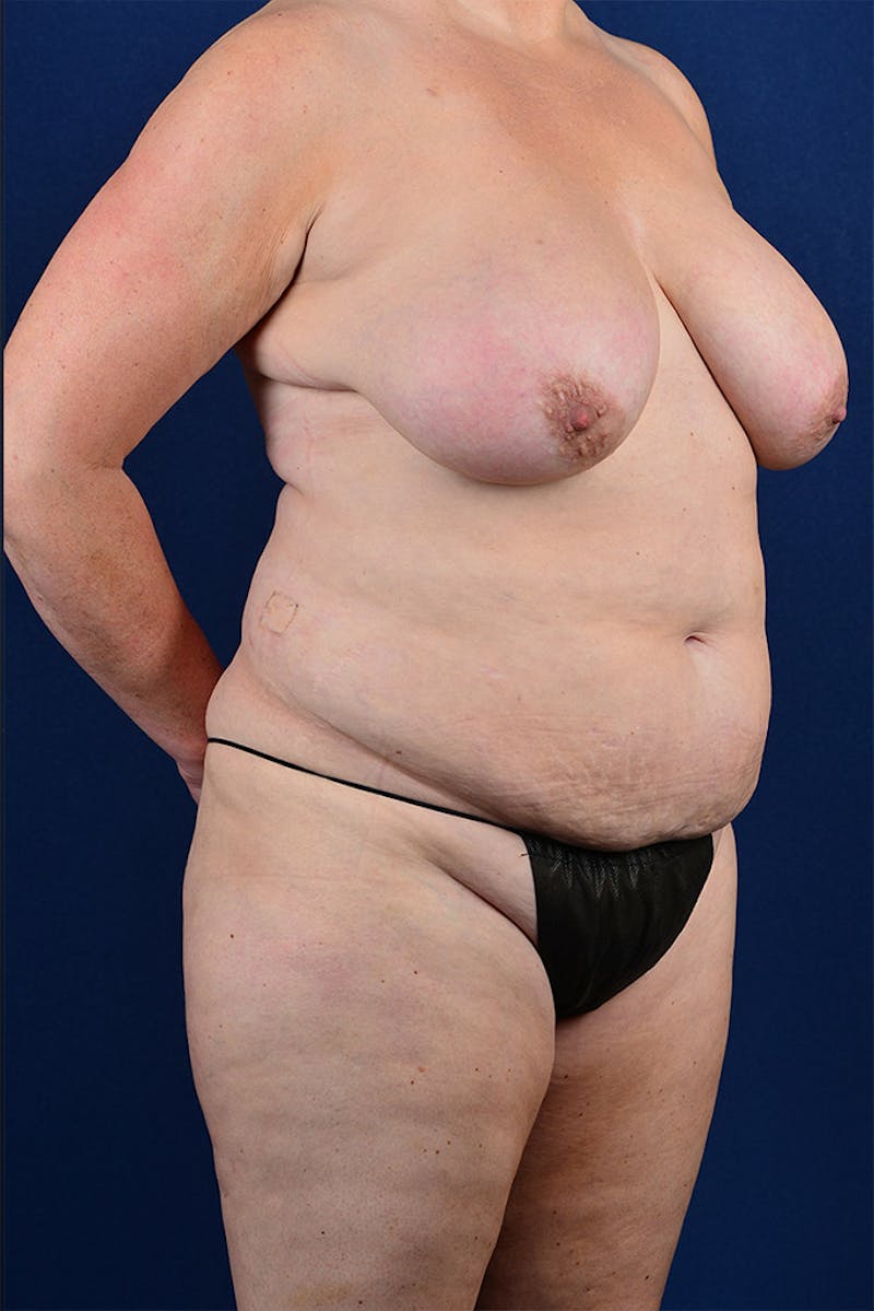 Extreme Body Contouring Before & After Gallery - Patient 9421744 - Image 5