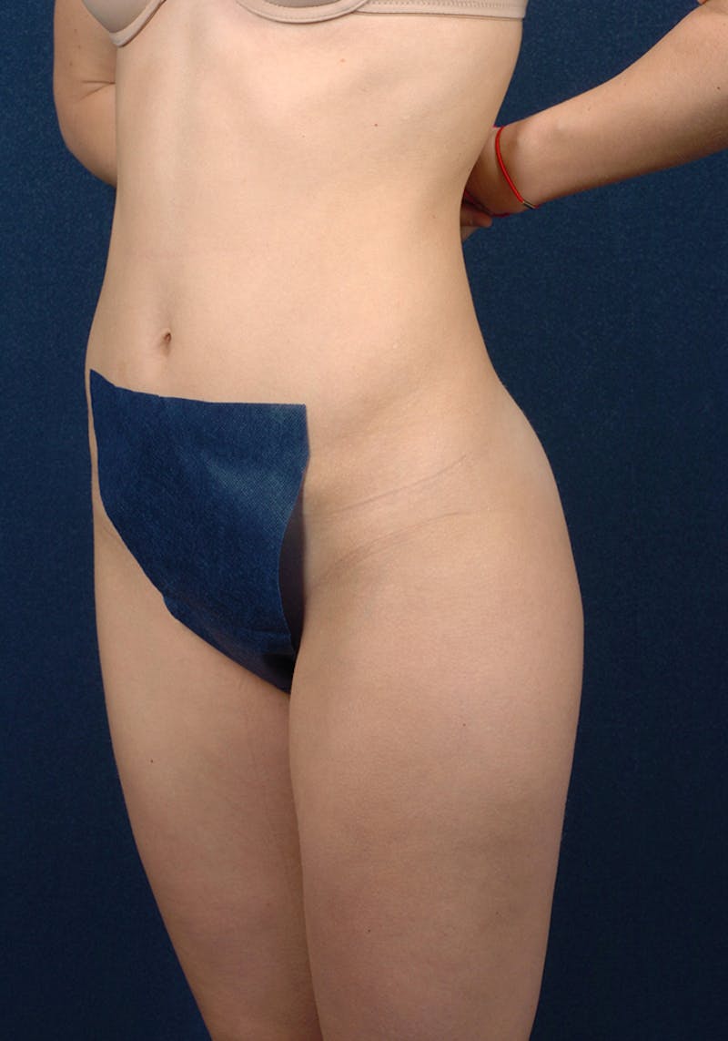 Female Liposuction Gallery - Patient 9421746 - Image 3