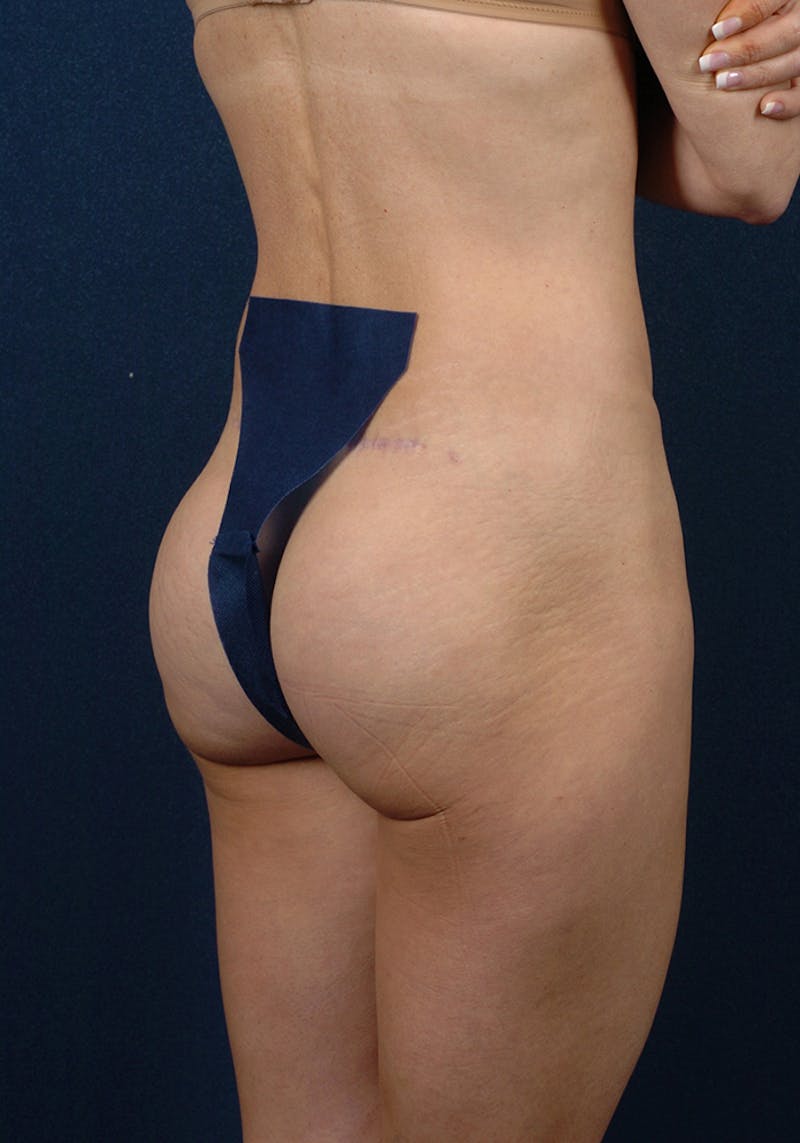 Gluteal Augmentation Before & After Gallery - Patient 9421747 - Image 4