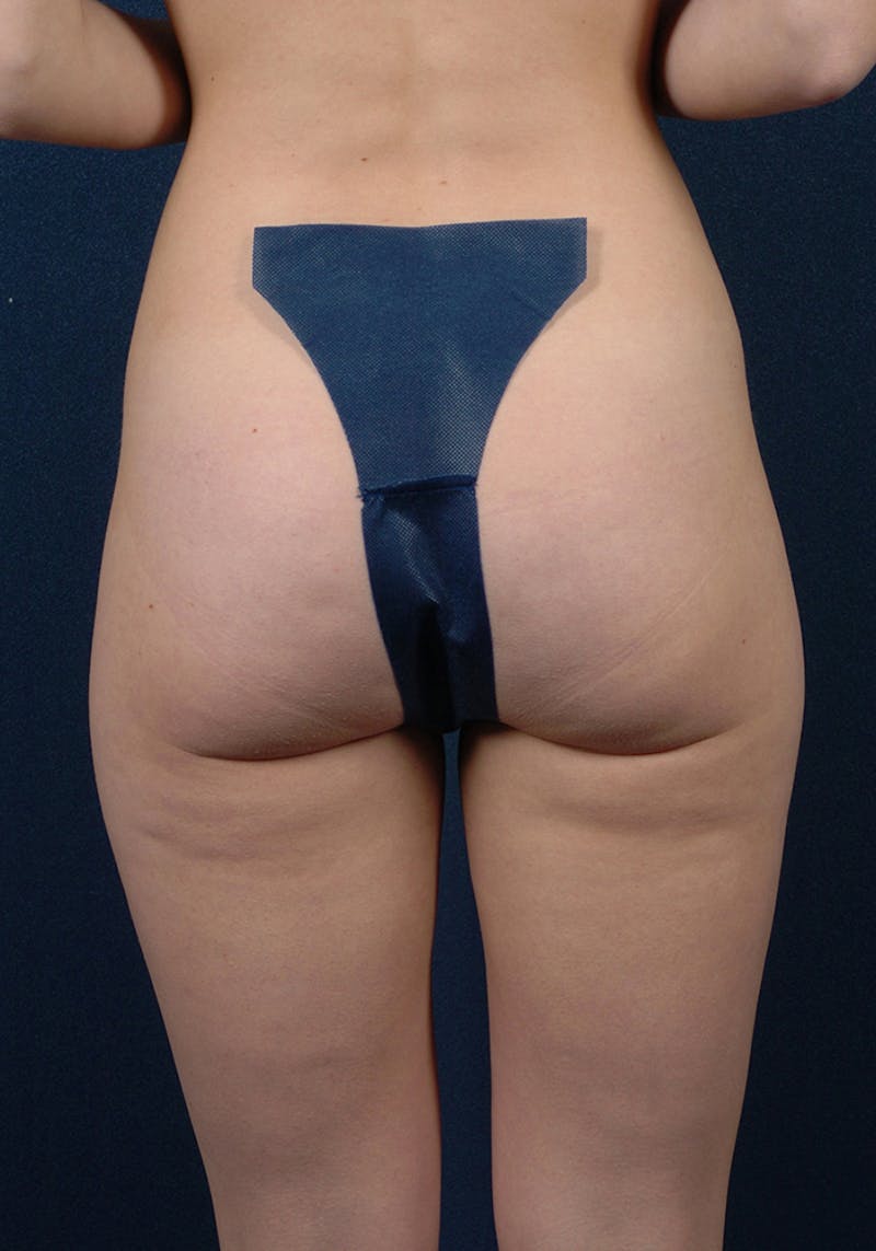 Female Liposuction Gallery - Patient 9421746 - Image 6