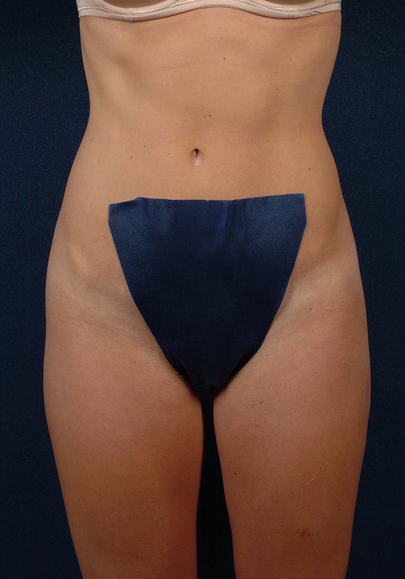 Female Liposuction Gallery - Patient 9421750 - Image 1