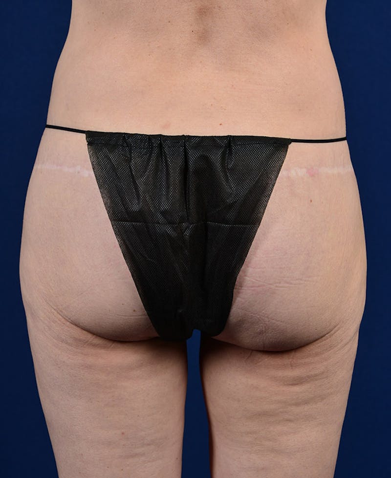 Gluteal Augmentation Before & After Gallery - Patient 9421749 - Image 1