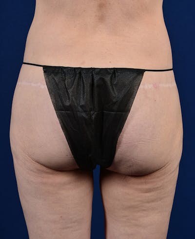 Gluteal Augmentation Before & After Gallery - Patient 9421749 - Image 1