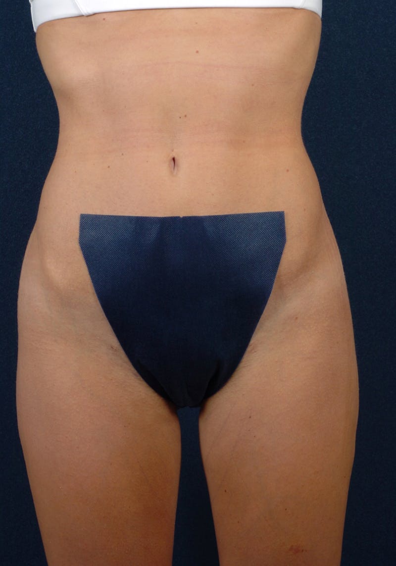 Female Liposuction Before & After Gallery - Patient 9421750 - Image 2