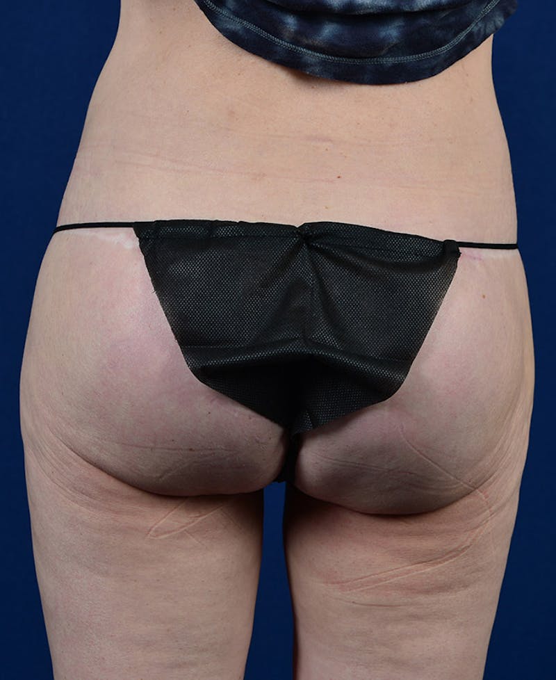 Gluteal Augmentation Gallery - Patient 9421749 - Image 2