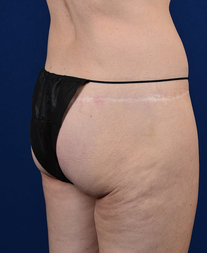 Gluteal Augmentation Gallery - Patient 9421749 - Image 3