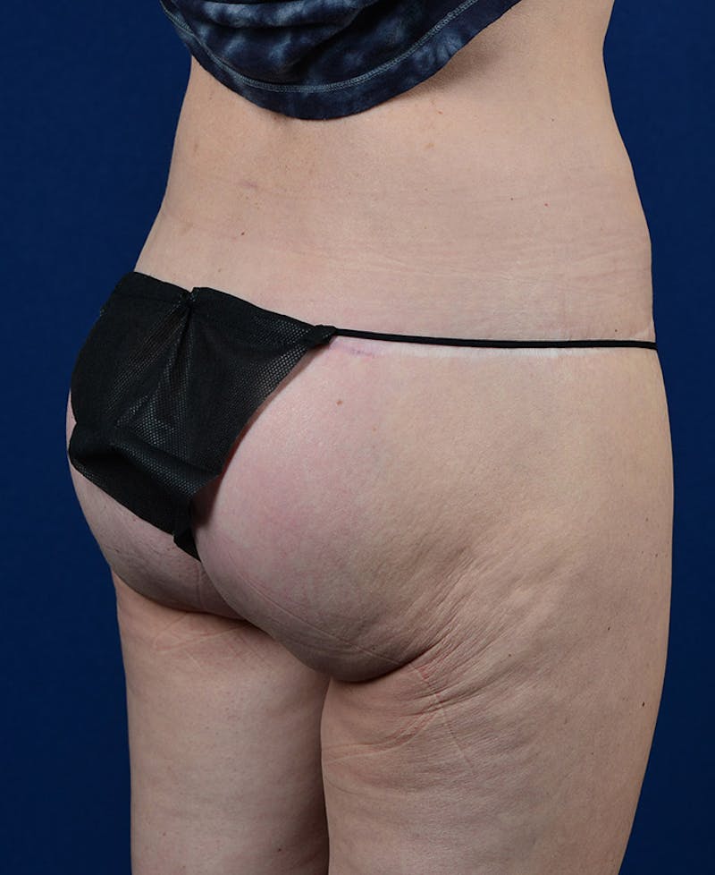 Gluteal Augmentation Gallery - Patient 9421749 - Image 4