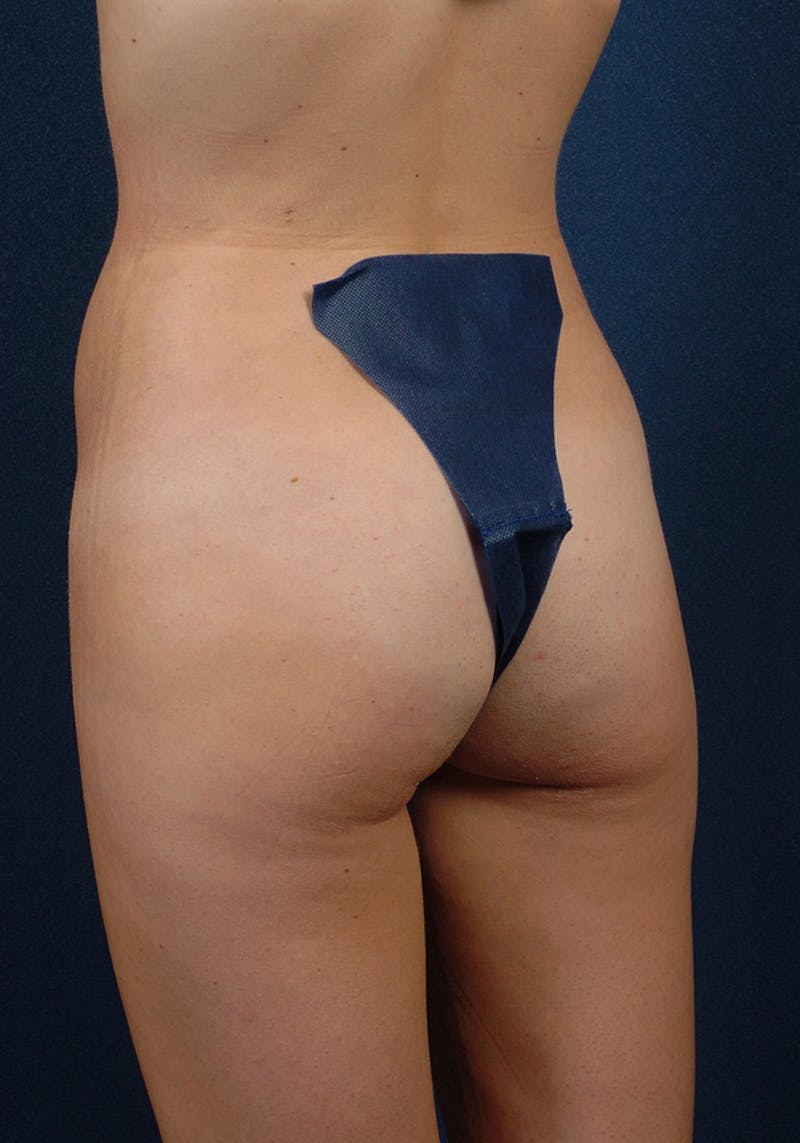 Female Liposuction Before & After Gallery - Patient 9421750 - Image 4