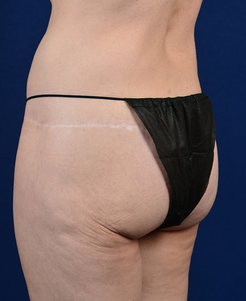 Gluteal Augmentation Before & After Gallery - Patient 9421749 - Image 5