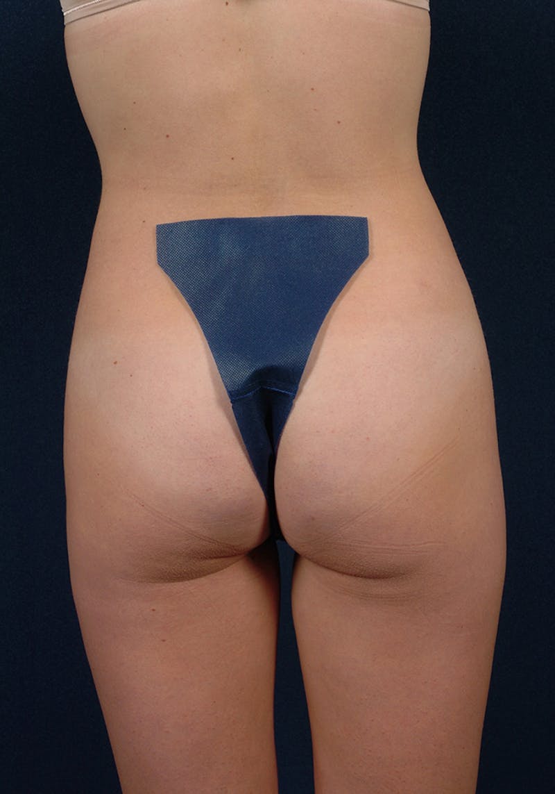 Female Liposuction Gallery - Patient 9421750 - Image 5