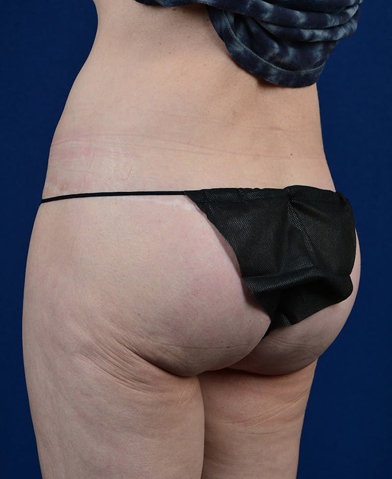 Gluteal Augmentation Before & After Gallery - Patient 9421749 - Image 6